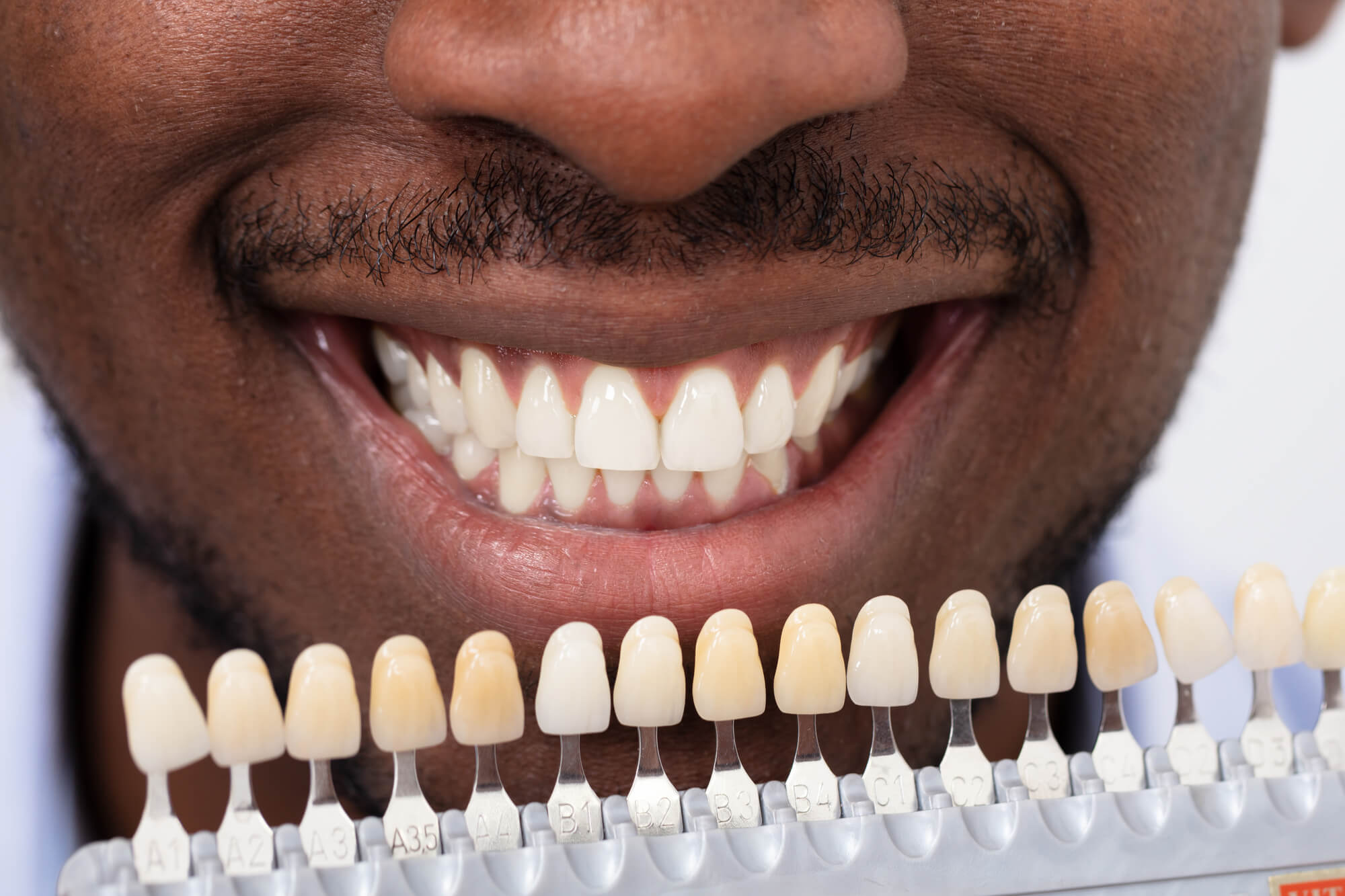 Close-up-Of-A-Smiling-African-Man-Holding-Set-Of-Implants-With-Various-Shades-Of-Tone